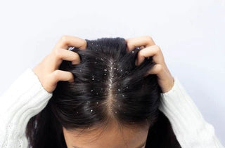 How to Get Rid of Dandruff Permanently - OMAKAZI BEAUTY